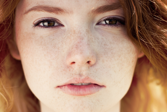Are you among those with freckled skin looking?