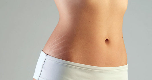 Effective home remedies for postpartum stretch marks.