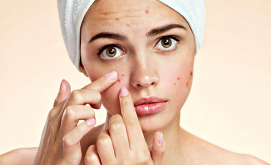 What your pimples say about your health!