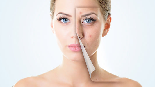7 foods to avoid for acne-free skin