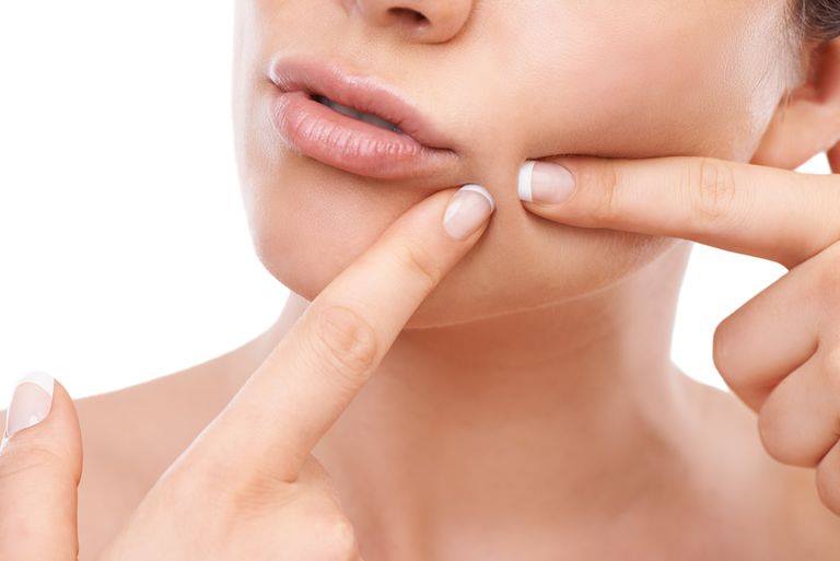 Blackheads-Never-Again