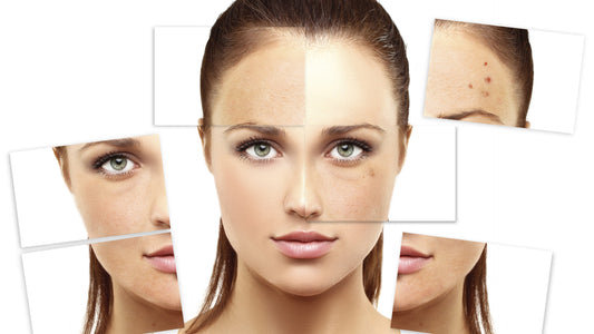 Dehydrated, oily and acne prone skin, all at that same time? Learn, how to handle it!