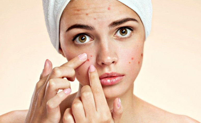 What your pimples say about your health!