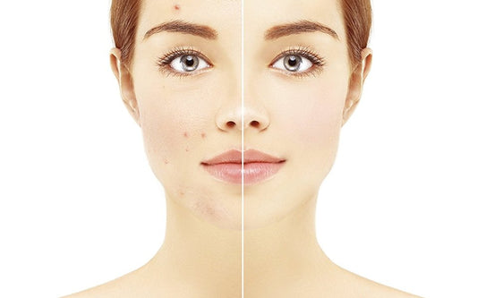 How to cure PCOS acne? Read this!