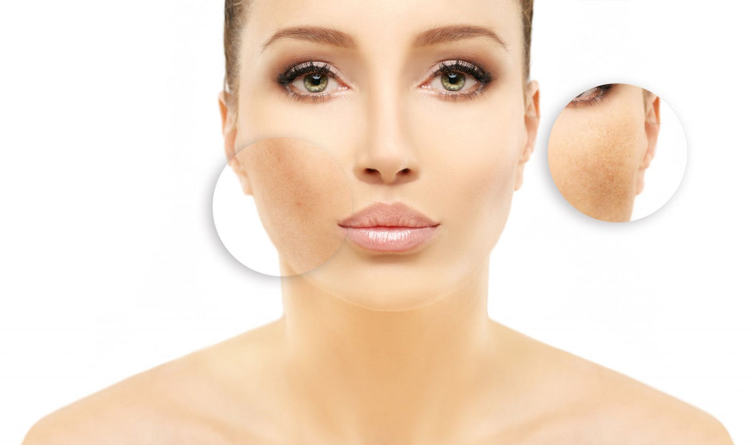 Hyperpigmentation - types, symptoms and treatments