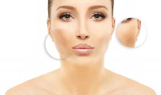 Hyperpigmentation - types, symptoms and treatments
