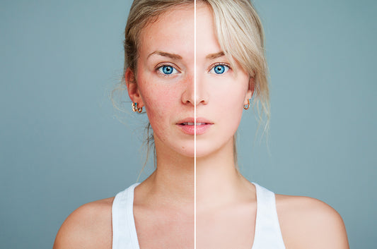 Rosacea - treatments and cures