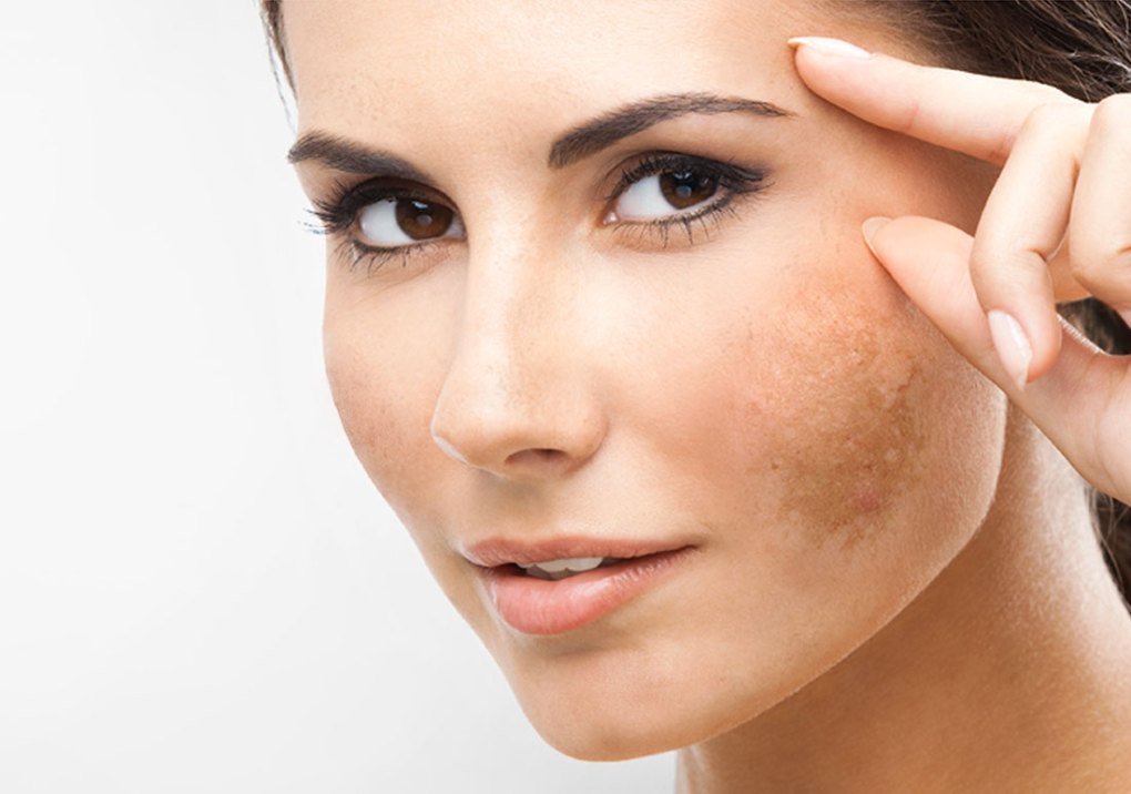 Skin pigmentation home remedies good to know about