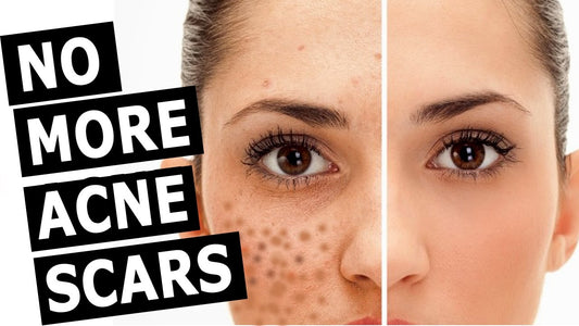 How to remove Acne Scars?