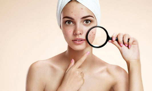 5 Best natural acne scar removers