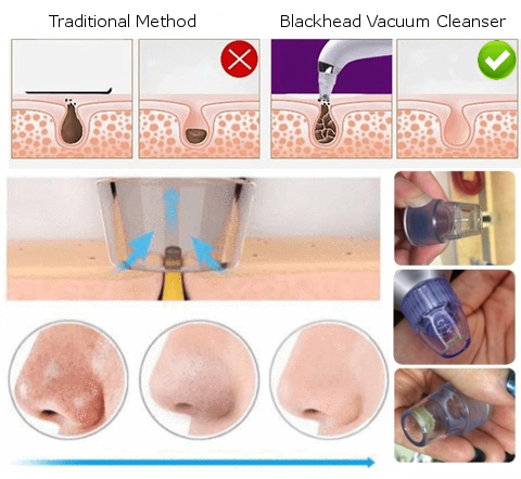 Crystal Secret - Blackhead Vacuum Cleanser